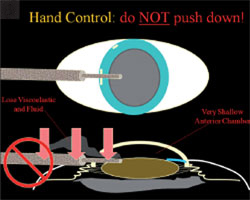 Figure 2. Pushing against the incision can cause wound gape