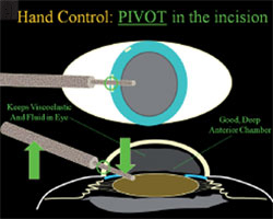 Figure 3. Pivoting within the incision