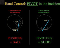 Figure 4. Pushing on the incision can cause extensive corneal deformation and straie