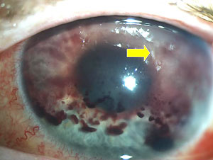 Slide 1. Anterior chamber blood and fibrin on postoperative day 1