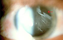 The anterior vitreous shows the crenellated hyaloids membrane in posterior vitreous detachment