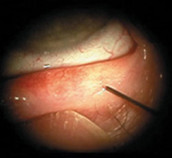 Penetration of the Maskin Meibomian Gland Intraductal Probe