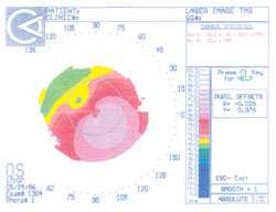 Corneal topography from 1996