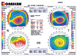 Observe the center thickness at the center apex