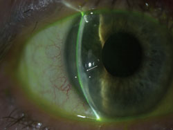 Slit lamp photo 1-day postop