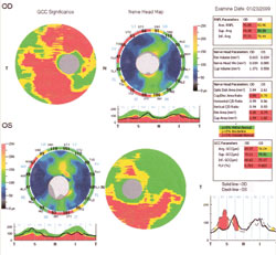  Figure 1. RTVue printouts for glaucoma patient