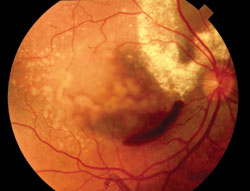 Figure 1. Home monitoring devices can be used to warn patients of the progression to wet AMD (pictured).