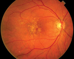 Figure 2. At risk and confirmed dry AMD (pictured) patients are encouraged to take nutrients.