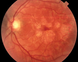 Figure 3. Vitamin A may increase the risk of advanced AMD by potentiating the development of geographic macular degeneration (pictured).