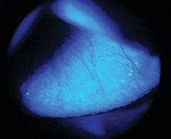 Figure 1. Typical GPC from soft contact lens wear under cobalt blue light with the use of fluorescein dye.