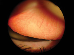 Figure 2. Clinicians attribute GPC to contact lens over wear and allergy.