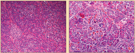 Figure 2. Pathology of Diffuse HI