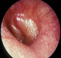 Acute otitis externa