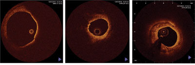 Figure 1. The three general plaque types: a thin fibrous cap (A); a lipid plaque (B); and a fibro-calcific plaque (C).