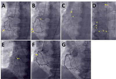 Figure A. Coronary angiography demonstrating a tortuous right coronary artery with a severe distal lesion.