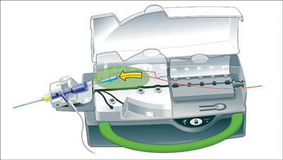 Figure 2. Illustration of loading the single-use cassette with a guidewire.