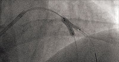 Figure 1. Culotte stenting of the left anterior descending artery and first diagonal branch from the right radial approach.