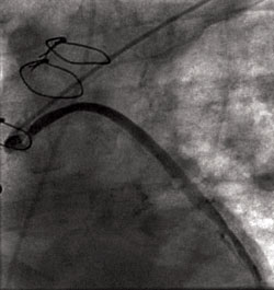 Figure 2. Stenosis of the proximal vein graft to the first marginal branch of the left circumflex artery. This area was stented from the left radial approach.