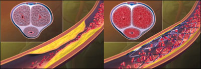 Figure. Left panel: Atherosclerotic narrowing in the internal pudendal artery resulting in poor arterial inflow and ED with suboptimal filling of penile cavernosal tissue. Right panel: Improved arterial inflow after implantation of a zotarolimus-eluting peripheral stent system.