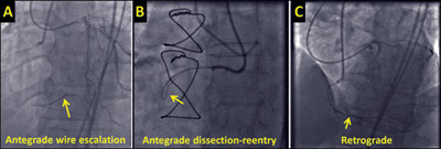 Figure. Examples of the three basic CTO crossing strategies. In panel A, dual coronary injection reveals that the wire (arrow) is advanced into the distal true lumen. In panel B, antegrade crossing is achieved by forming a knuckle (arrow) that is advanced 