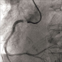 Figure 1. Subtotal ostial right coronary artery occlusion due to in-stent restenosis.