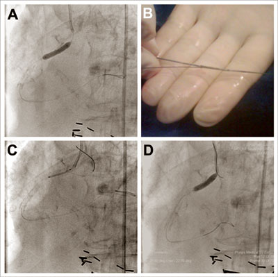 Figure 2. Panel A: Lesion preparation by predilatation using a 4-mm × 20-mm non-compliant balloon. Panel B: Threading of anchor wire through proximal stent struts. Panel C: Positioning of ostial stent with anchor wire prolapsed into aortic root. Panel D: A