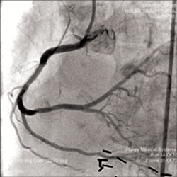 Figure 3. Satisfactory final angiographic result with TIMI III flow observed.