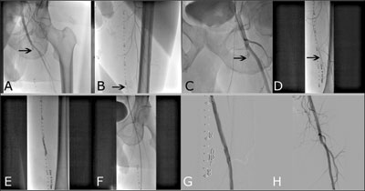 Figure. Left superficial femoral artery (SFA) intervention in a patient with lifestyle-limiting claudication and in-stent restenosis at 6 months follow-up. Panel A: Arrow indicates proximally occluded left SFA. Panel B: Distal reconstitution of the left SF