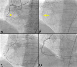 Figure. Panel A: Coronary angiography demonstrating a CTO of the mid right coronary artery. Panel B: After failure to cross the lesion antegradely, a Fielder FC (Asahi Intecc) guidewire was advanced retrogradely from the left anterior descending artery thr