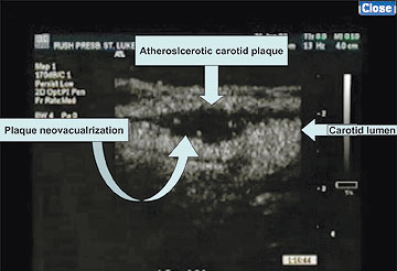 Contrast-enhanced image of a patient undergoing a routine carotid ultrasound examination