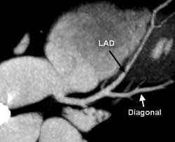 Normal left anterior descending coronary artery (LAD)