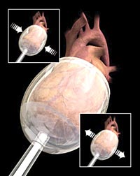 Myo-VAD cardiac support syste