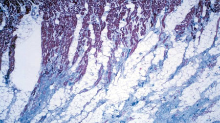  Histological section of right ventricular myocardium showing fibrofatty replacement of myocytes.