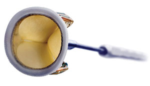 The Trifecta aortic valve can now be used in US patients undergoing CABG.