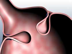 Stomach tissue being suctioned into the Stomaphy X device to create a pleat of tissue