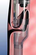 Stomach tissue being suctioned into the Stomaphy X device to create a pleat of tissue