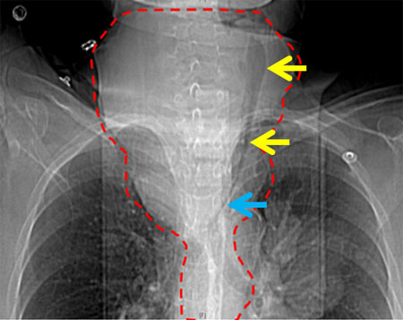 Figure 1. Coronal CT scan of neck and thorax without contrast.