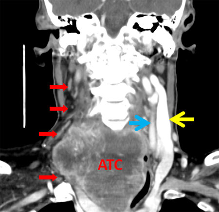 Figure 2. Coronal CT scan of the neck with contrast.