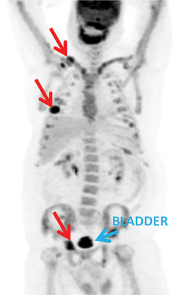 Figure 1. 18F-FDG PET scan. Multiple hypermetabolic sites in the skeleton were identified on the anterior-posterior planar image.