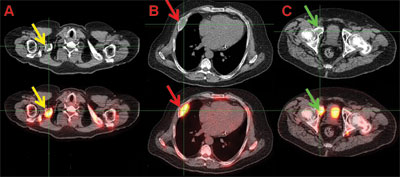 Figure 2. 18F-FDG PET/CT scan. The axial CT scan alone (upper row) and fused the 18F-FDG PET scan (lower row) showing the hypermetabolic, expansile, cystic lesions of the bones. A) right clavicle (yellow arrows); B) right lateral rib (red arrows); and C) right acetabulum (green arrows).