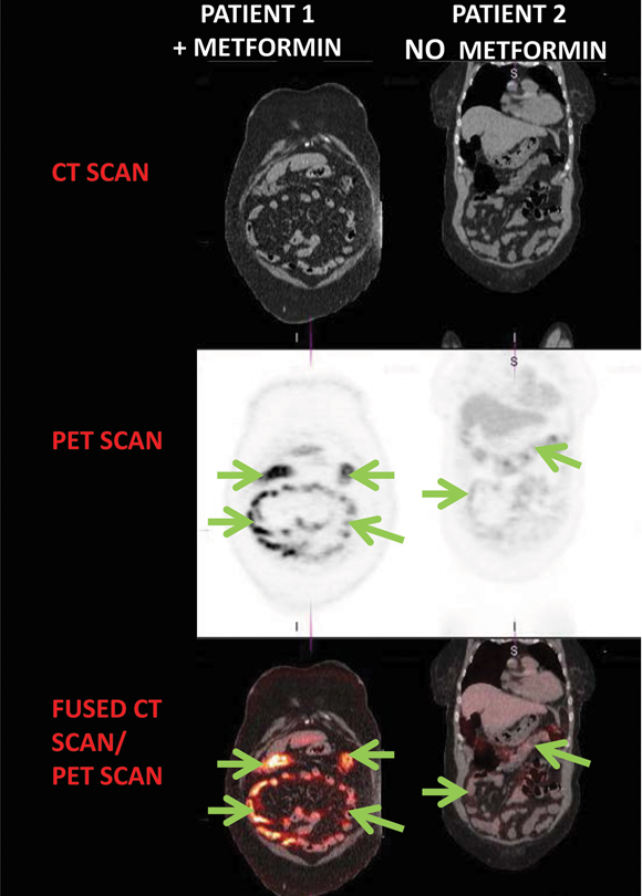 Coronal views of 18F-FDG SPECT/CT scan