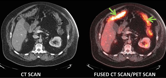 Axial views of 18F-FDG SPECT/CT scan