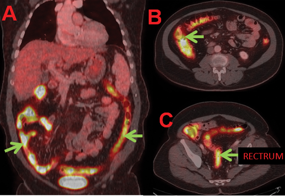 Colorized 18F-FDG SPECT  PET scan fused with CT scan