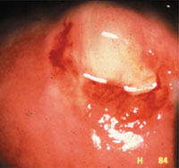 colposcopy