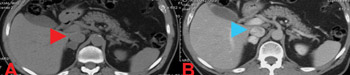 Figure 1: Axial CT scan of the abdomen showing a pheochromocytoma. 