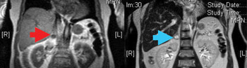 Figure 2: Coronal images of a MRI of a pheochromocytoma. 