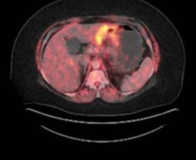 Figure 1: PET/CT at the time of diagnosis