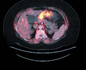 Figure 2: PET/CT at the time of diagnosis