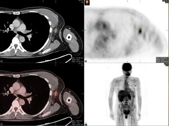 Figure 1: Axial PET/CT