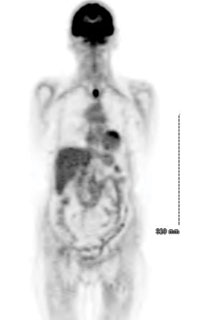 Figure 1: PET scan demonstrating proximal tracheal lesion